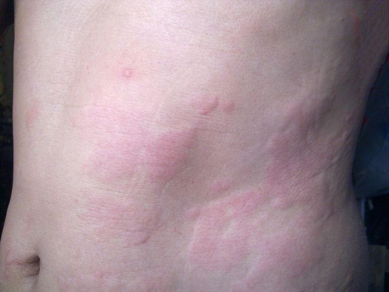 Dermatomiozita: Cauze, manifestari si tratament